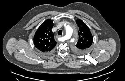 Kommerell diverticulum – egy ritka betegség ritka szövődményei