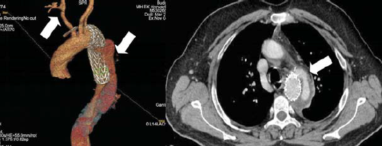 Kommerell diverticulum – egy ritka betegség ritka szövődményei