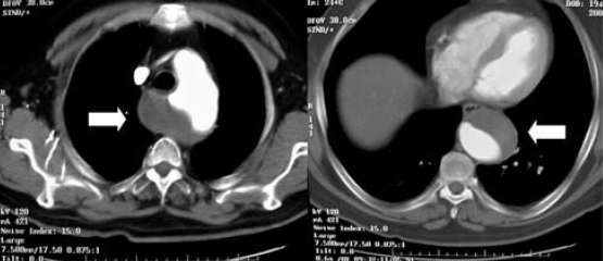 Kommerell diverticulum – egy ritka betegség ritka szövődményei