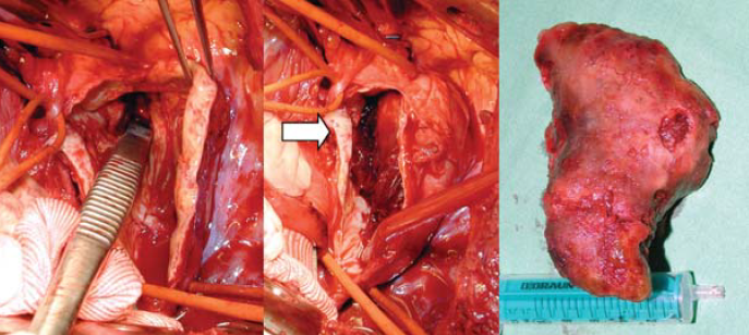 Kommerell diverticulum – egy ritka betegség ritka szövődményei