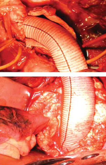 Kommerell diverticulum – egy ritka betegség ritka szövődményei