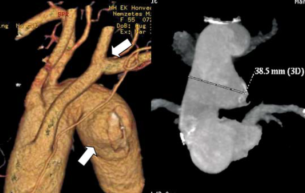 Kommerell diverticulum – egy ritka betegség ritka szövődményei