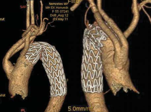 Kommerell diverticulum – egy ritka betegség ritka szövődményei