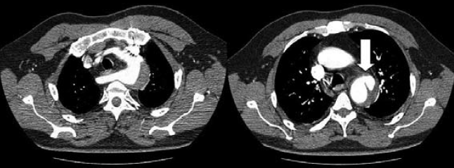 Kommerell diverticulum – egy ritka betegség ritka szövődményei