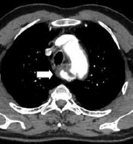 Kommerell diverticulum – egy ritka betegség ritka szövődményei