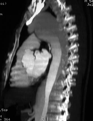 Aorta dissectiók zsigeri szövődményei