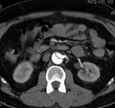 Aorta dissectiók zsigeri szövődményei