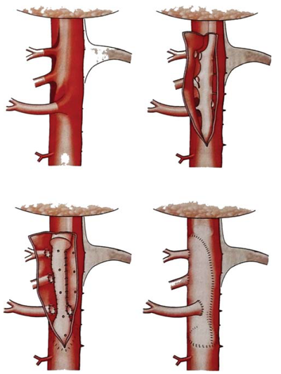 Aorta dissectiók zsigeri szövődményei