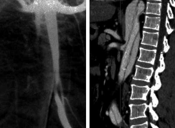 Aorta dissectiók zsigeri szövődményei