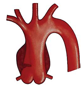 Aorta dissectiók zsigeri szövődményei