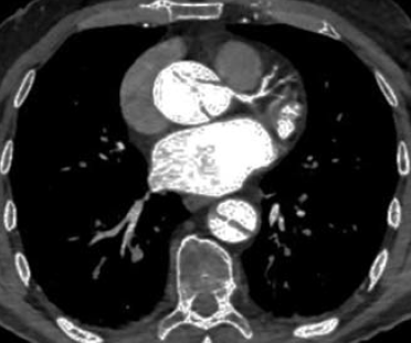 Aorta dissectiók zsigeri szövődményei