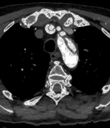 Aorta dissectiók zsigeri szövődményei