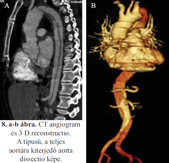 Aorta dissectiók zsigeri szövődményei