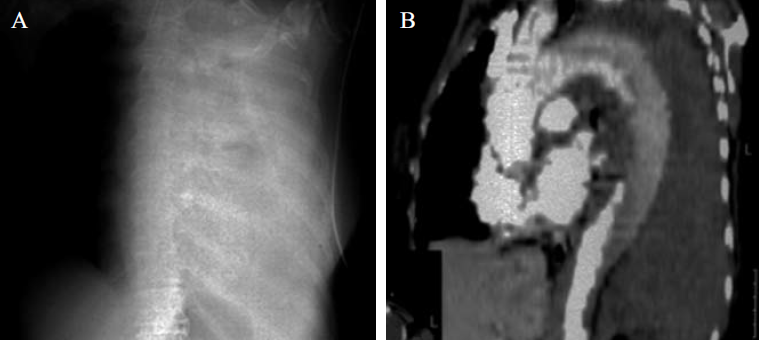 Aorta dissectiók zsigeri szövődményei