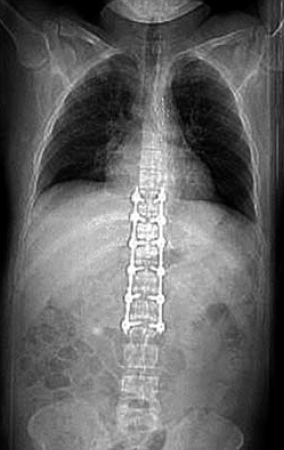 Sebészi megoldások krónikus multivisceralis arteriás elzáródások eseteiben