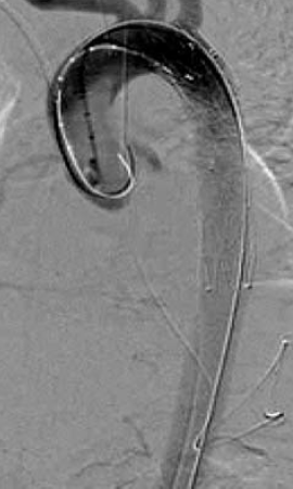 Sebészi megoldások krónikus multivisceralis arteriás elzáródások eseteiben