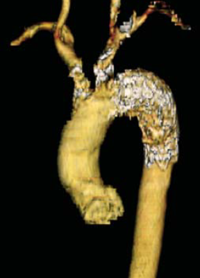 Sebészi megoldások krónikus multivisceralis arteriás elzáródások eseteiben