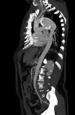 Sebészi megoldások krónikus multivisceralis arteriás elzáródások eseteiben