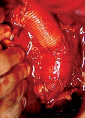 Sebészi megoldások krónikus multivisceralis arteriás elzáródások eseteiben