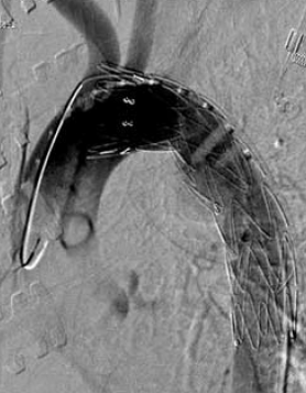 Sebészi megoldások krónikus multivisceralis arteriás elzáródások eseteiben