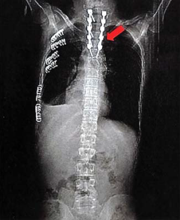 Sebészi megoldások krónikus multivisceralis arteriás elzáródások eseteiben