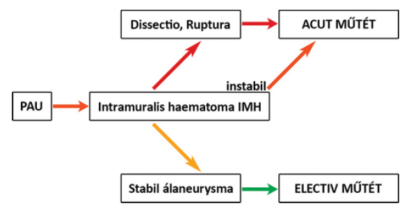 A mellkasi aorta penetráló atheromás ulcusa