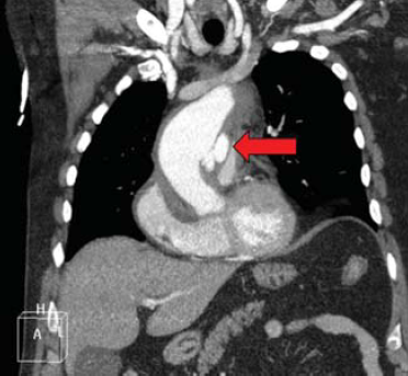 A mellkasi aorta penetráló atheromás ulcusa