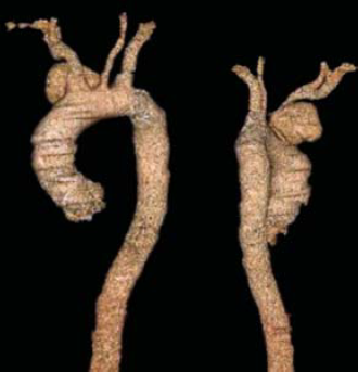 A mellkasi aorta penetráló atheromás ulcusa