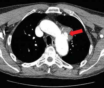 A mellkasi aorta penetráló atheromás ulcusa