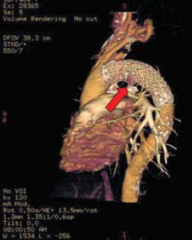 A mellkasi aorta penetráló atheromás ulcusa