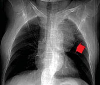 A mellkasi aorta penetráló atheromás ulcusa