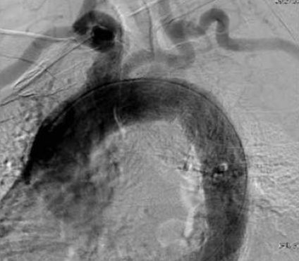 A mellkasi aorta penetráló atheromás ulcusa