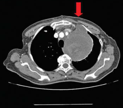 A mellkasi aorta penetráló atheromás ulcusa