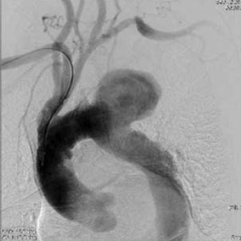 A mellkasi aorta penetráló atheromás ulcusa