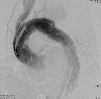 A mellkasi aorta penetráló atheromás ulcusa