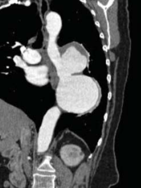 A mellkasi aorta penetráló atheromás ulcusa