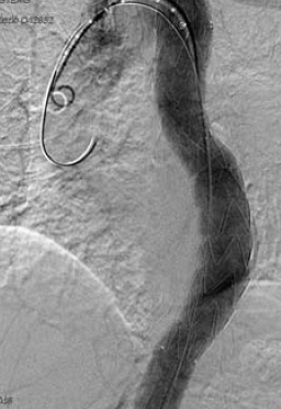 A mellkasi aorta penetráló atheromás ulcusa