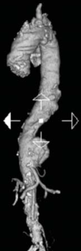 A mellkasi aorta penetráló atheromás ulcusa