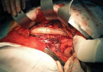 A mellkasi aorta penetráló atheromás ulcusa