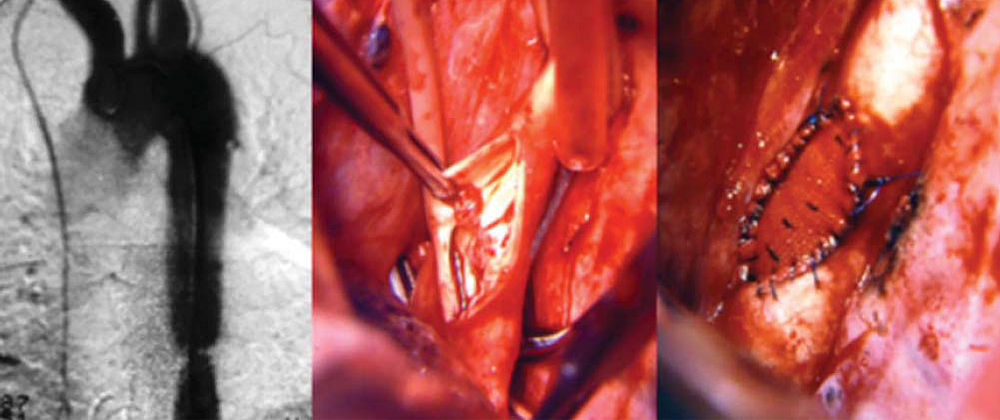 Atípusos aorta coarctatiok sebészi kezelésének hosszú távú eredményei Atípusos aorta coarctatiok sebészi kezelésének hosszú távú eredményei