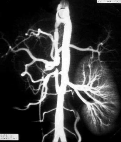 Atípusos aorta coarctatiok sebészi kezelésének hosszú távú eredményei