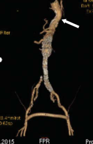 Atípusos aorta coarctatiok sebészi kezelésének hosszú távú eredményei Atípusos aorta coarctatiok sebészi kezelésének hosszú távú eredményei