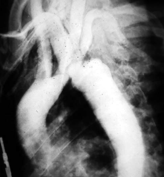 Atípusos aorta coarctatiok sebészi kezelésének hosszú távú eredményei