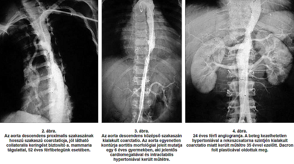 Atípusos aorta coarctatiok sebészi kezelésének hosszú távú eredményei Atípusos aorta coarctatiok sebészi kezelésének hosszú távú eredményei
