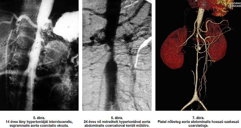 Atípusos aorta coarctatiok sebészi kezelésének hosszú távú eredményei Atípusos aorta coarctatiok sebészi kezelésének hosszú távú eredményei