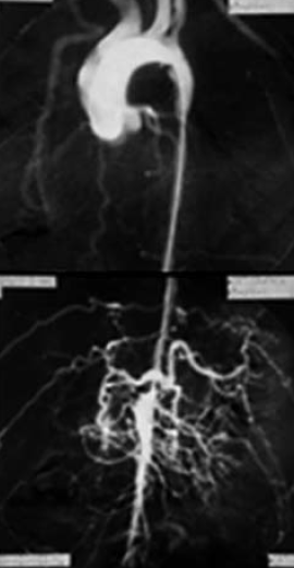 Atípusos aorta coarctatiok sebészi kezelésének hosszú távú eredményei