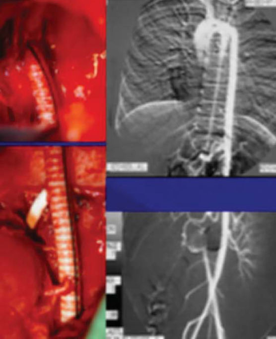 Atípusos aorta coarctatiok sebészi kezelésének hosszú távú eredményei