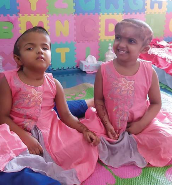 A bangladesi sziámi ikrek szétválasztása - II. rész