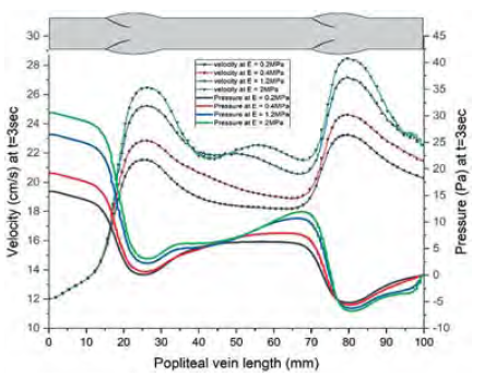 A vena popliteán belüli áramlás matematikai modellezése rugalmas és merev falú billentyűk esetén